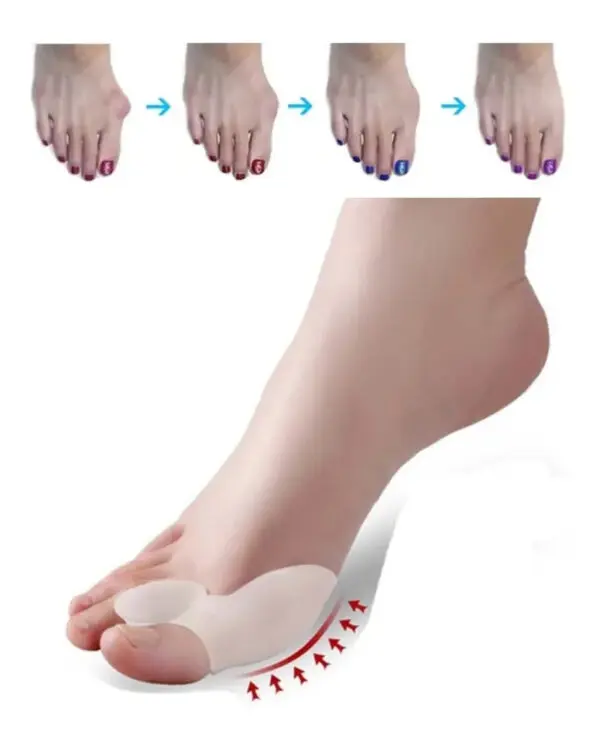 Corrector de juanete de silicona para aliviar el dolor y alinear el dedo gordo del pie.