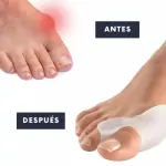 Set x2 Pares Corrector De Juanete Silicona: pie antes y después con separador de dedos para alinear el dedo gordo.