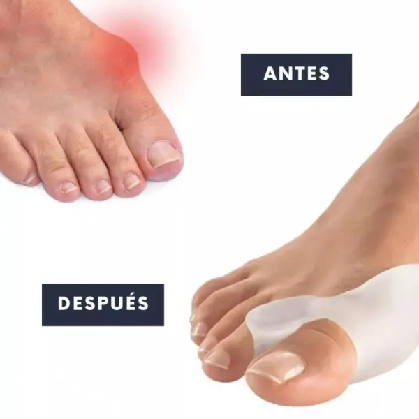 Set x2 Pares Corrector De Juanete Silicona: pie antes y después con separador de dedos para alinear el dedo gordo.
