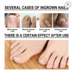Aceite reparador de uñas: cura el crecimiento encarnado de las uñas del pie, de leve a severo.