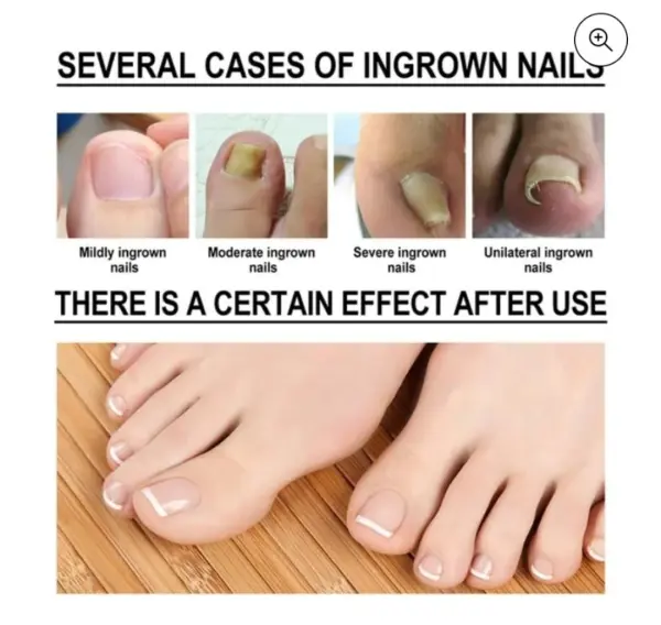 Aceite reparador de uñas: cura el crecimiento encarnado de las uñas del pie, de leve a severo.