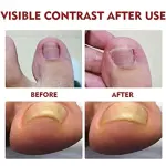 Aceite Reparador De Uñas: contraste antes y después, mostrando mejora de uñas afectadas.
