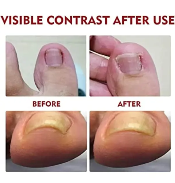 Aceite Reparador De Uñas: contraste antes y después, mostrando mejora de uñas afectadas.