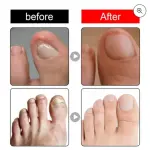 Aceite reparador de uñas: antes y después, mostrando la mejora de uñas gruesas y dañadas.