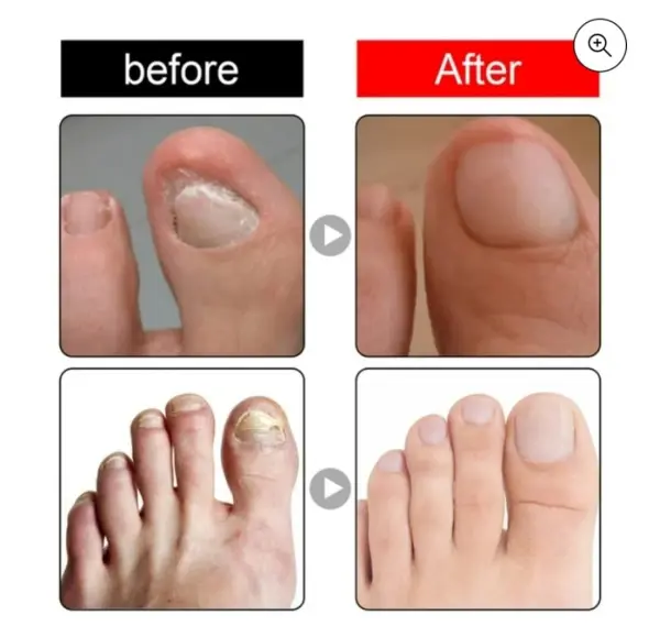Aceite reparador de uñas: antes y después, mostrando la mejora de uñas gruesas y dañadas.