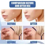 Skin Tag Parche: comparación antes y después, removiendo verrugas faciales y corporales.