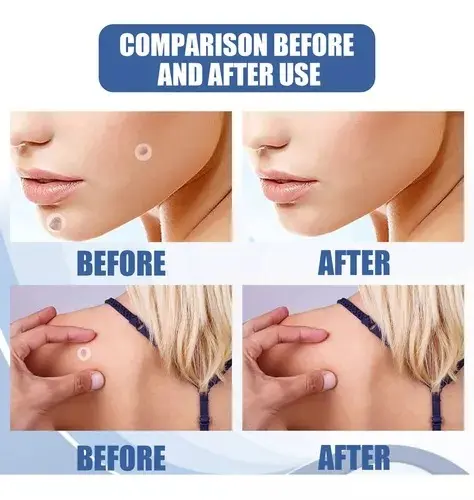 Skin Tag Parche: comparación antes y después, removiendo verrugas faciales y corporales.