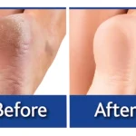 Pies Perfectos: talón agrietado antes y después del tratamiento hidratante.