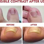 Set x2 Hongos Toenail Plus: Toe health before and after use
