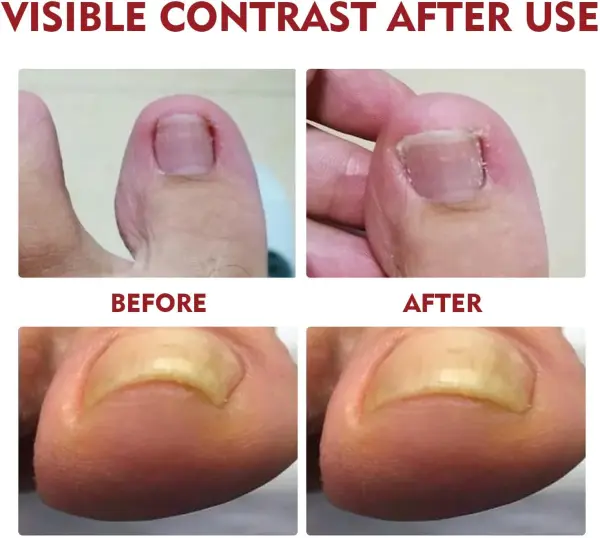 Set x2 Hongos Toenail Plus: Toe health before and after use