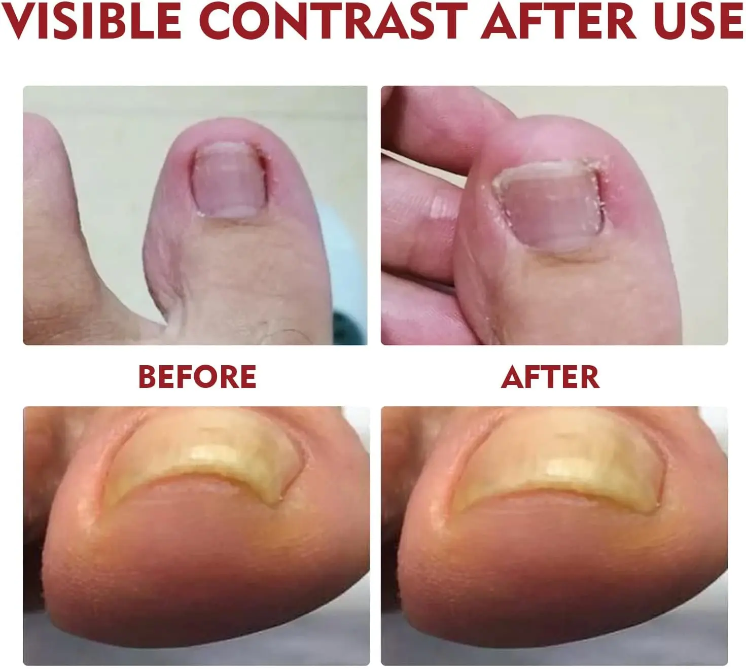Set x2 Hongos Toenail Plus: Toe health before and after use