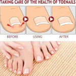 Set x2 Hongos Toenail Plus: Antes y después de tratar uñas con hongos.