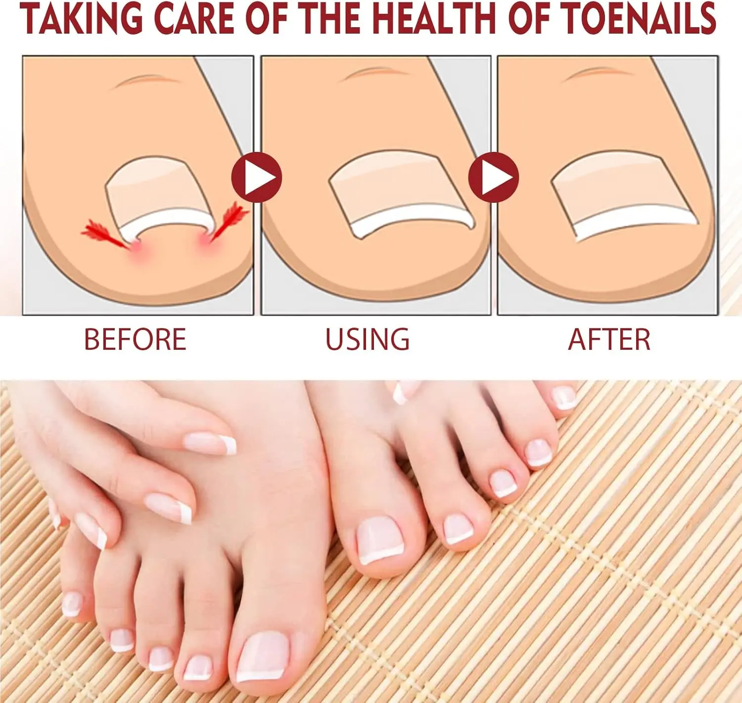 Set x2 Hongos Toenail Plus: Antes y después de tratar uñas con hongos.