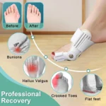 Férula correctora de juanete con soporte para hallux valgus, dedos torcidos y pies planos.