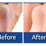 Pies Perfectos: antes y después de talones agrietados y piel suave.