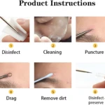 Extracción de espinillas: desinfección, limpieza, punción, arrastre y eliminación de suciedad.