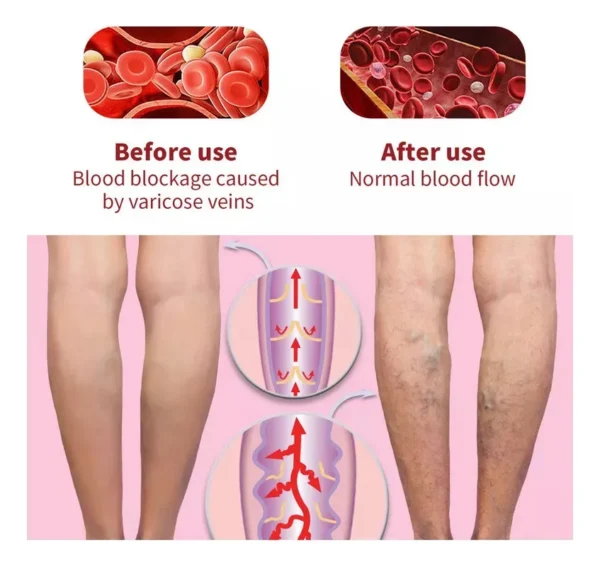 Crema Beevana: mejora flujo sanguíneo y reduce venas varicosas en las piernas.