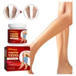 Crema para várices y arañas vasculares, alivia flebitis. Muestra antes y después en piernas.