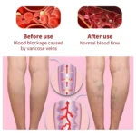 Crema Beevana: Antes (venas varicosas) y después (flujo sanguíneo normal) en piernas.