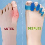 Pie con separador de silicona para corregir juanetes "antes y después".