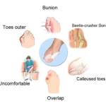 Corrector de juanetes de silicona para aliviar dolor, superposición de dedos y callosidades.