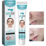JAYSUING 7 Days Acne Control Gel con AHA & BHA, tratamiento facial para eliminar acné en envase de 20g/0.7fl oz.