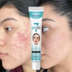 Crema control de acné Jaysuing, antes y después, piel con acné mejorada.