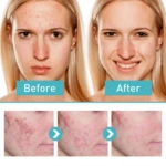Crema para el acné con antes y después: rostro con imperfecciones y rostro mejorado.