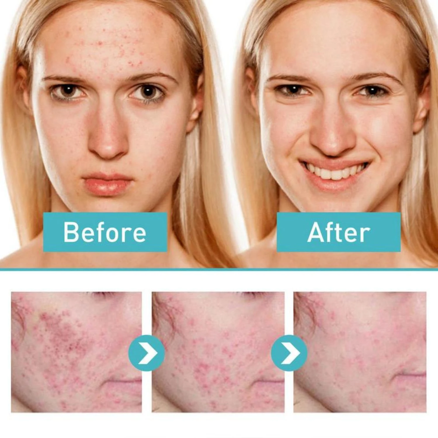 Crema para el acné con antes y después: rostro con imperfecciones y rostro mejorado.