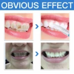 Lapiz blanqueador dental: antes y después de dientes amarillos y con manchas, mostrando el resultado blanco y brillante.