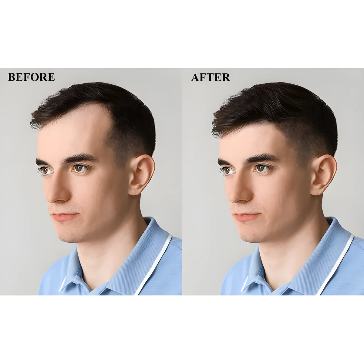 Comparativa antes y después de hombre con Elixir Crecimiento Capilar Fortalecedor, mostrando aumento de densidad capilar.