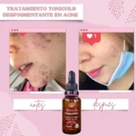 Comparativa de piel con acné antes y después del uso de Tónico LB de 30 ml, un tratamiento despigmentante que reduce manchas y controla la grasa facial.