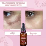 Comparativa de antes y después del uso de Tónico LB despigmentante de 30 ml, un tratamiento aclarante que reduce manchas y controla la grasa en la piel.