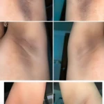 Barra exfoliante con barro marino para aclarar axilas, antes y después, mostrando reducción de manchas y piel suave.