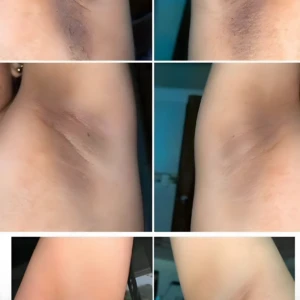 Barra exfoliante con barro marino para aclarar axilas, antes y después, mostrando reducción de manchas y piel suave.