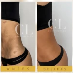Antes y después de crema corporal bronceadora con brillo dorado, unifica tono y disimula estrías.