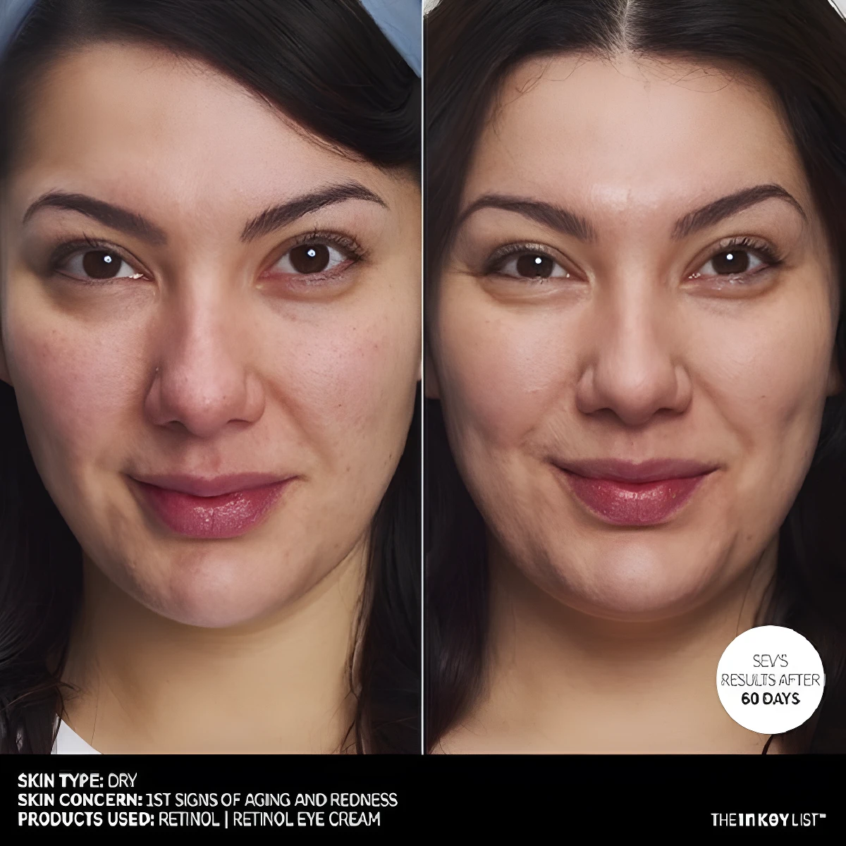 Comparativa de rostro antes y después de usar The INKEY List Retinol Antiedad: piel más lisa y uniforme.