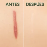 Antes y después de aplicar gel de aloe vera en cicatriz queloide, mostrando reducción de enrojecimiento y relieve.