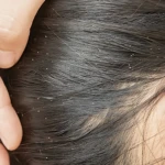 Persona revisando cabello oscuro con piojos y liendres blancos, cerca de la oreja.