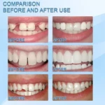 Moldeador para Dentadura - Imagen 2