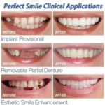 Carillas Dentales Onsmile - Imagen 3