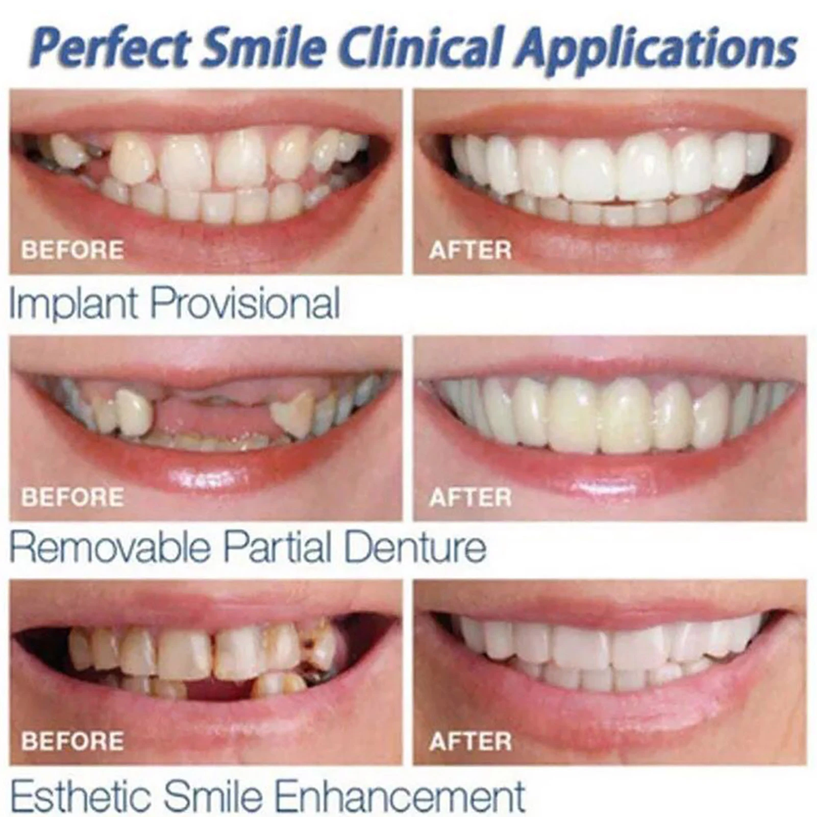 Comparación antes y después de carillas dentales Onsmile, mostrando mejora estética en sonrisas con dientes faltantes o manchados.