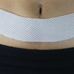 Lamina en Gel Post-Cirugia de Abdomen