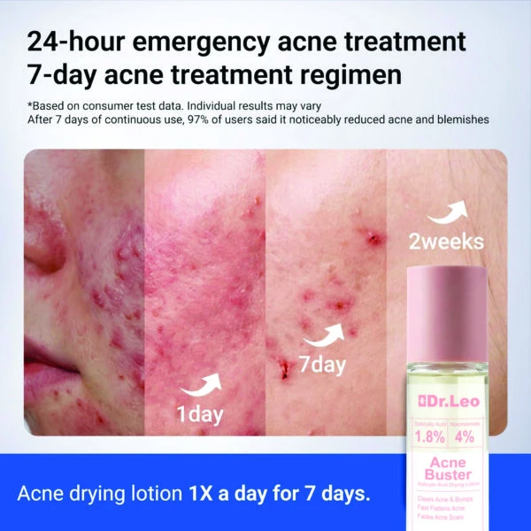 Dr. Leo Acné Buster con Salicílico 30Ml