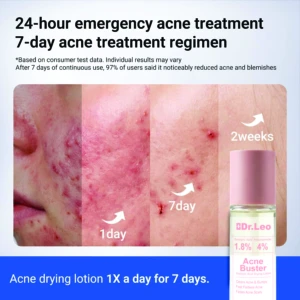 Loción desecante Dr. Leo con ácido salicílico y niacinamida 30ml - Reduce brotes y manchas en solo 7 días de uso constante