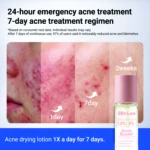 Loción secadora Dr. Leo en presentación de 30 ml, con etiqueta rosa y texto blanco. Muestra resultados visuales de uso: piel con granos al día 1, mejoría al día 7 y piel clara a las 2 semanas. Ideal para tratamiento de acné en 7 días.