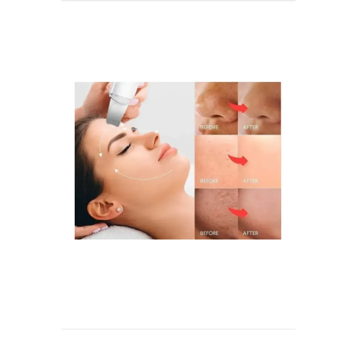 Mujer recibiendo tratamiento facial con dispositivo ultrasónico; paneles comparativos muestran mejora en textura, poros y luminosidad de la piel tras uso.