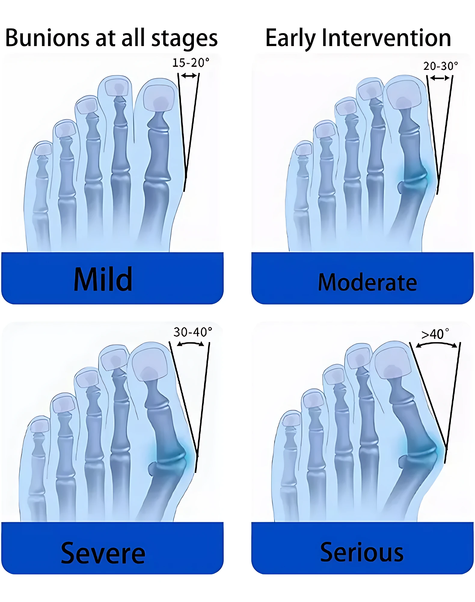 Diagrama de rayos X mostrando cuatro etapas de juanete con ángulos de 15-20°, 20-30°, 30-40° y más de 40°, ilustrando progresión desde leve a grave.