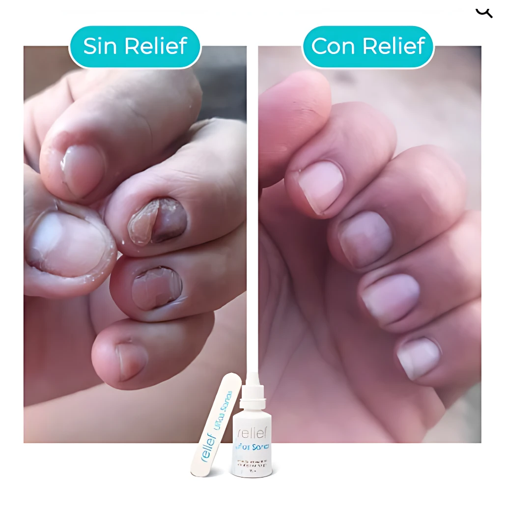 Comparativa de uñas afectadas por hongos antes y después del tratamiento con gotas que curan uñas con hongos, mostrando mejora en textura y color.