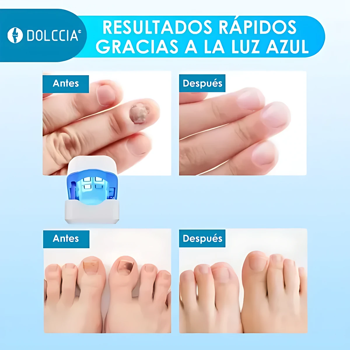 Comparación antes y después del tratamiento con láser azul portátil Dolccia, mostrando uñas afectadas por hongos en manos y pies, y su aspecto restaurado tras uso.